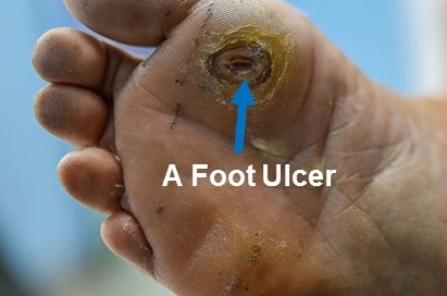 Grade 1 diabetic foot ulcer in an Afreican