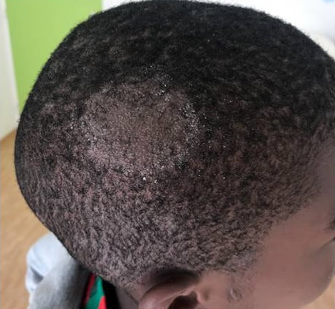 African boy with tinea infection of right scalp