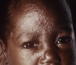 An African child showing typical measles rash on his face