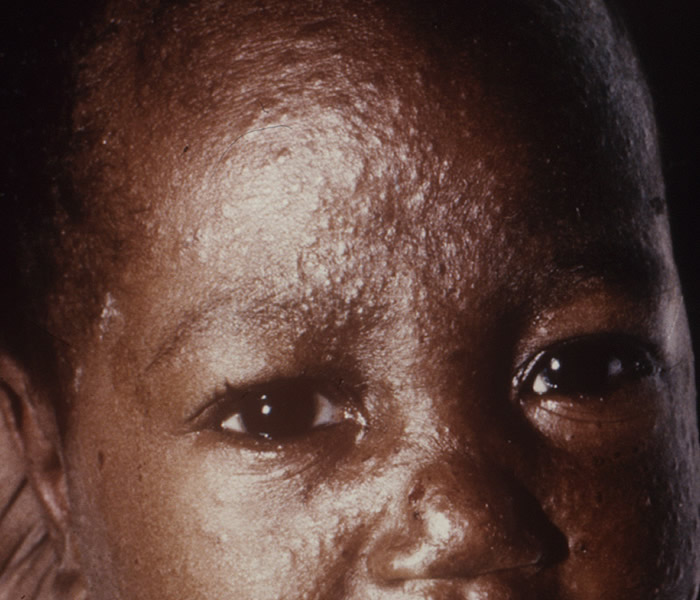 African child with typical measles rash on face