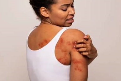 A black frican lady with seborrheic dermatitis on back of chest
