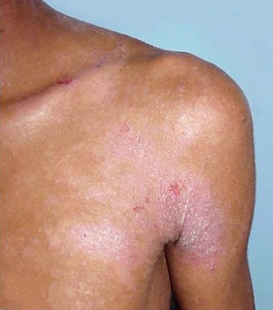 A black African man with atopic dermatitis on the front of chest, left shoulder and upper arm