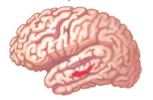 Image of brain in a 75years-old patient with Azheimer's dementia