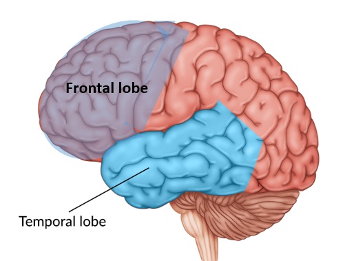 Left side view of the brain showing the areas affected most by frontotemoral dementia, the frontal and temporal lobes