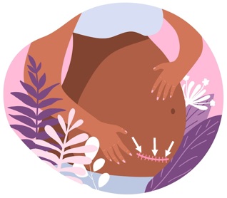 Cartoon illustration showing the location of the caesarian section incision in a brown skinned avatar of a pregnant lady