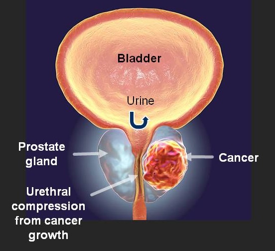 Cartoon illustration showing cancer growth in the prostate