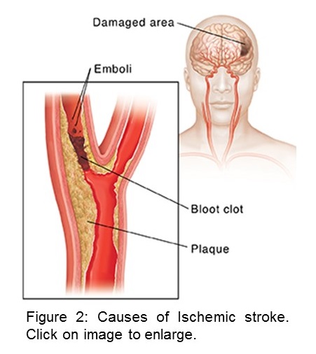 Causes of ischemic stroke