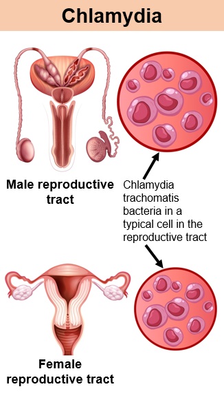 Cartoon illustration of the male and female reproductive tracts with inserts of the chlamydia bacteria