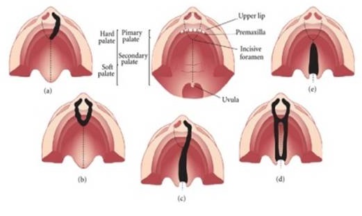 Types of clefts