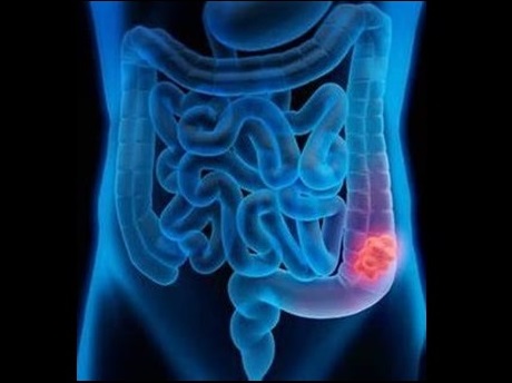 Cartoon image showing location of colon cancer 