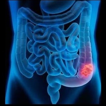 Image showing a common site for the location of colon cancer in humans. 
