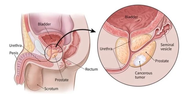 Illustration showing the location of the prostate gland below the bladder with a cancer growth shown.