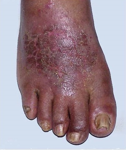Contact dermatitis in the front of left foot of a black African man
