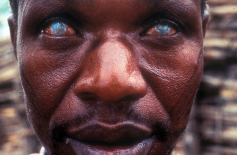 African man blinded by onchocerciasis
