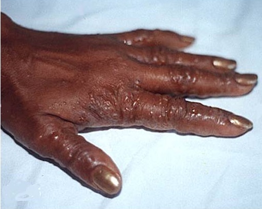 Dyshidrotic eczema on the back of the left hand of an African lady