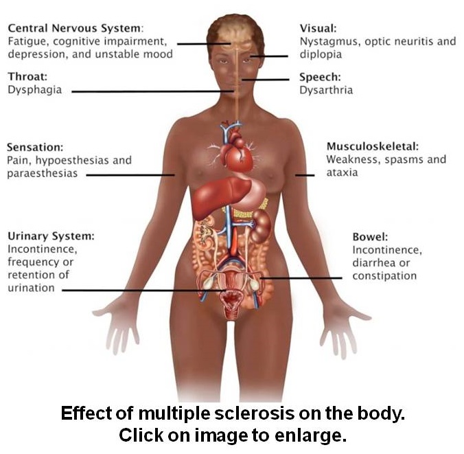 Effects of multiplr sclerosis on the body