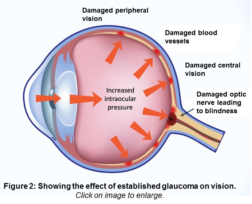 Image showing the effect of glaucoma on vision