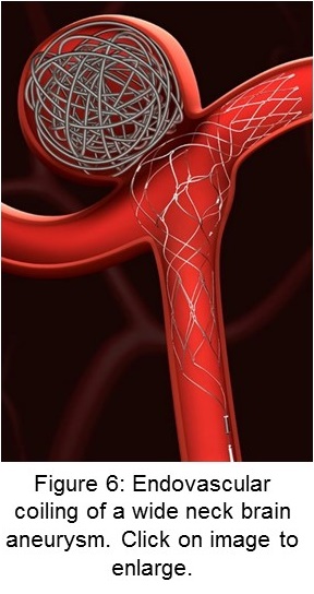 Treatment of brain aneurysm - endovascular coiling