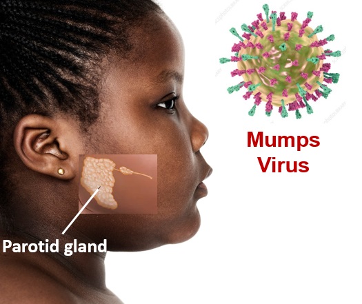 Close up left-sided view of an african girl with inlay showing the location of the parotid gland which is a common site for mumps attack