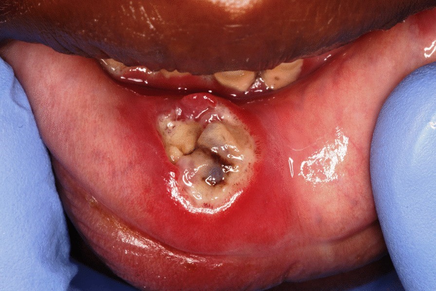 Noma, showing early stage of lip ulceration