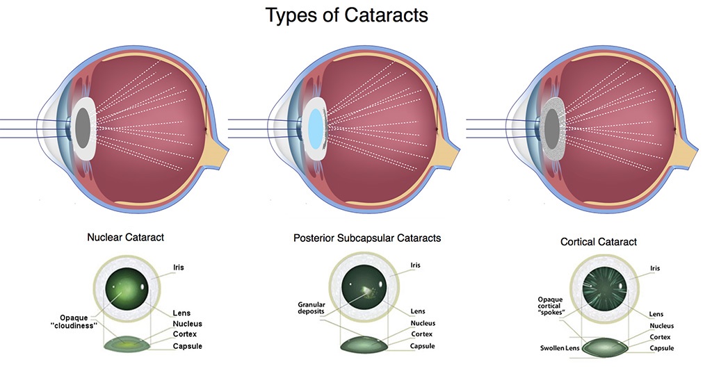 Image showing the categories of cataract