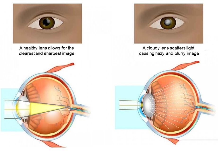 Effect of cataract on vision.