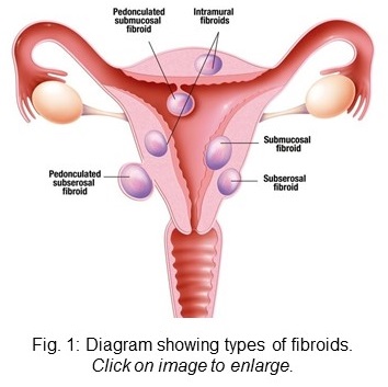 Diagram showing types of fibroids. 