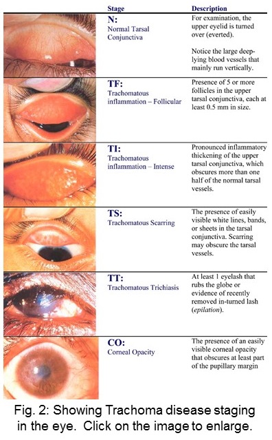 Image showing normal tarsal conjunctiva and the five stages of trachoma disease with a brief description for each.
