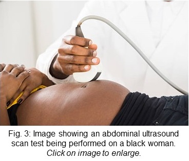 Image showing an abdominal ultrasound scan test being performed on a black woman