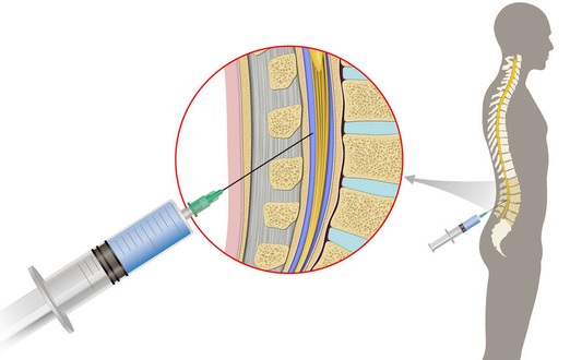 An illustration of a lumbar puncture procedure