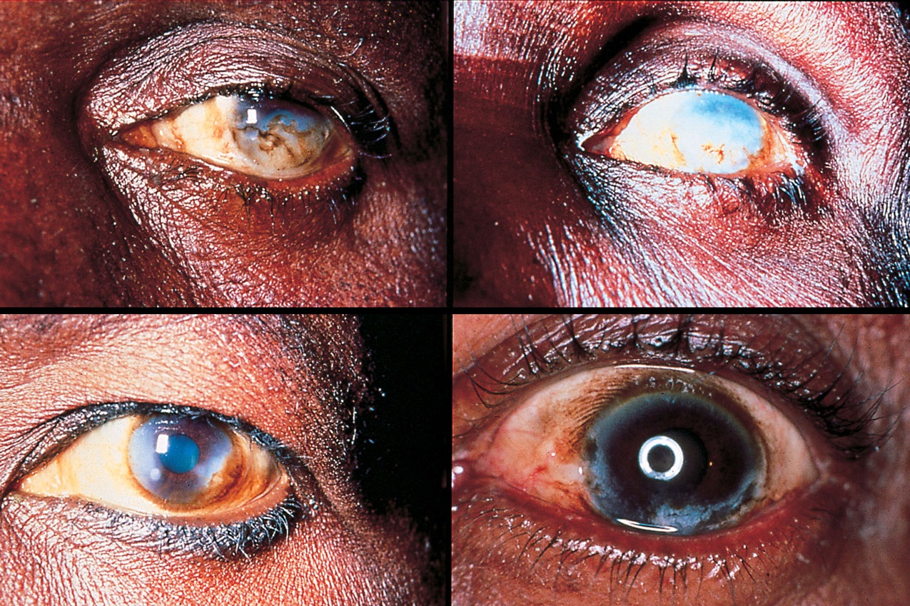 Appearance of eye disease caused by onchocerciasis