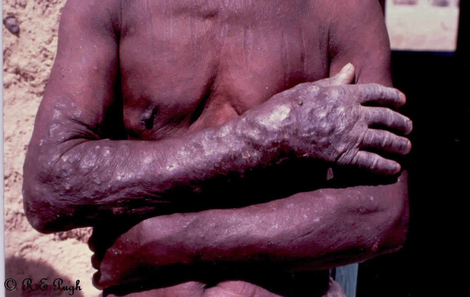 Skin nodules of onchocerciasis patient