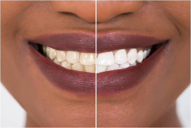 Teeth discolouration