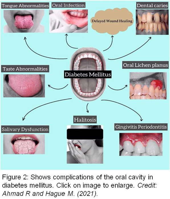 Figure 2: Oral complications of diabetes mellitus