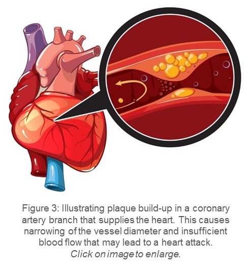 Illustration showing plaquw buildup in a branch of the coronary artery,