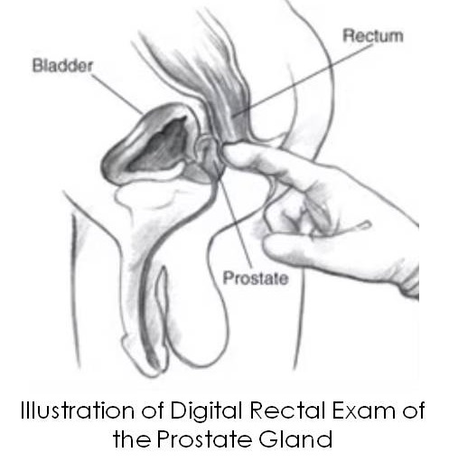 Illustration of digital rectalexamination