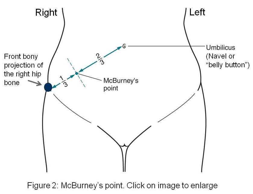 McBurney's point