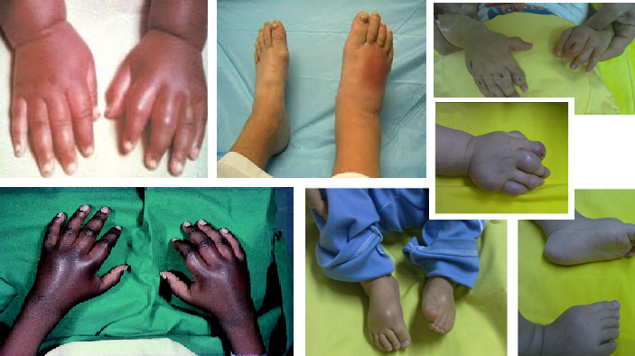 Image collage of Hand and Foot Syndrome (Dactylitis) in children with Sickle Cell Disease {SCD}