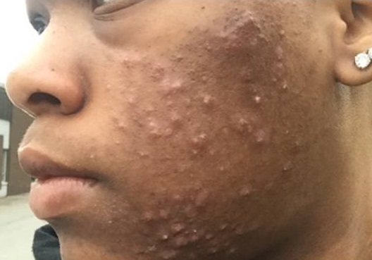 Man with facial acne