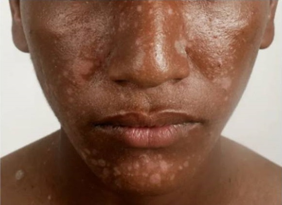 Black man with facial eczema (atopic dermatitis)