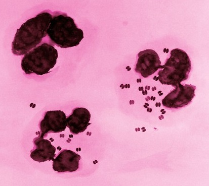 Photomicrograph showing Neisseria gonorrheae organism in cells obtained from vaginal swab 