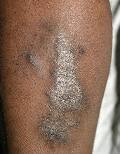 Neurodermatitis of the front of  knee and upper leg in a black African man
