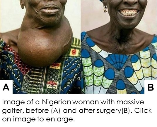 Nigerain woman with a large goiter, pre and post syrgery