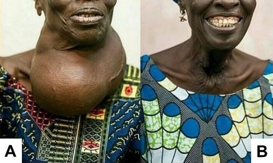 African woman with large goiter. Pre and post surgery