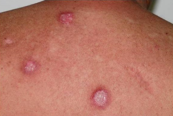 Nummular (Discoid) eczema on the upper back of a black African woman