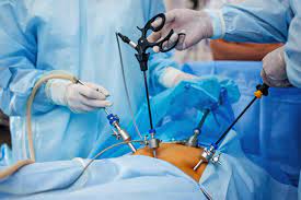 Laparoscopic myomectomy scene showing surgeons holding multiple instrument through incisions in a patient;s abdomen