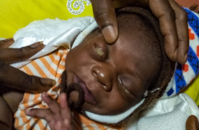 Ophthalmia Neonatorun due to gonococcal infection.