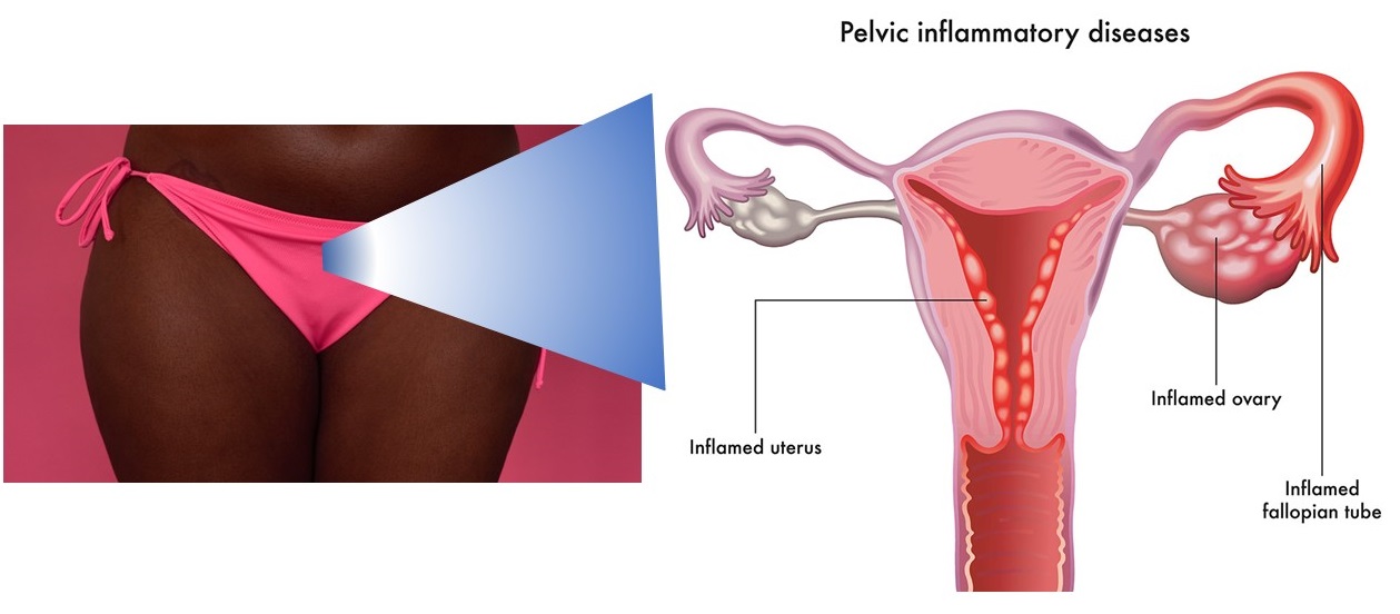 Image depicting structures affected in Pelvic Inflammatory Disease in a woman