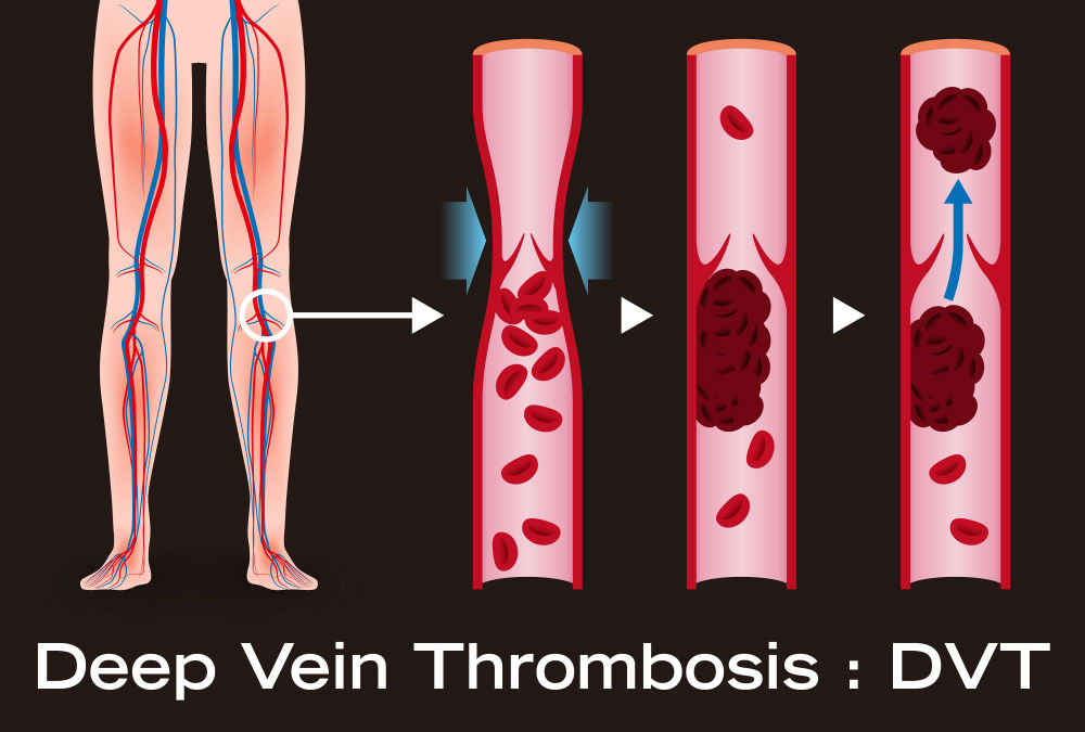 Risk of Deep Vein Thrombisis (DVT)