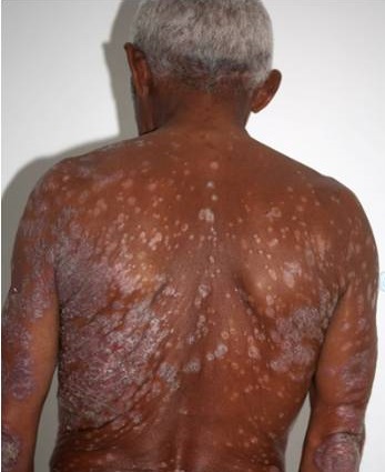 An African man with a HIV skin condition on the back